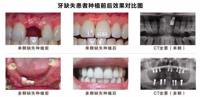 富华种植牙前后对比图-富华美容牙科