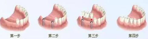 种植牙流程图-富华美容牙科