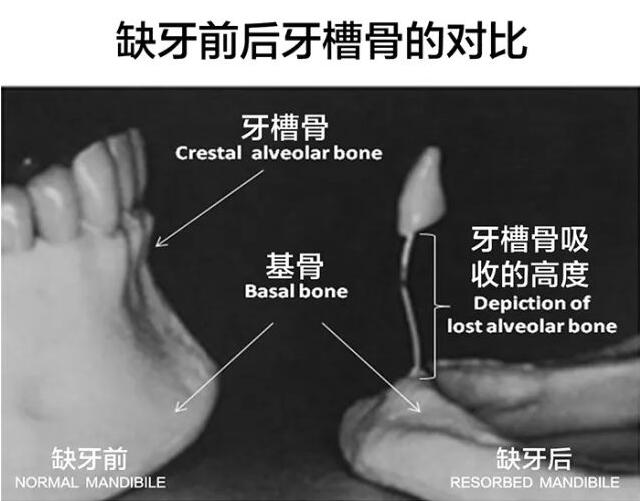 缺牙前后牙槽骨对比图-富华美容牙科