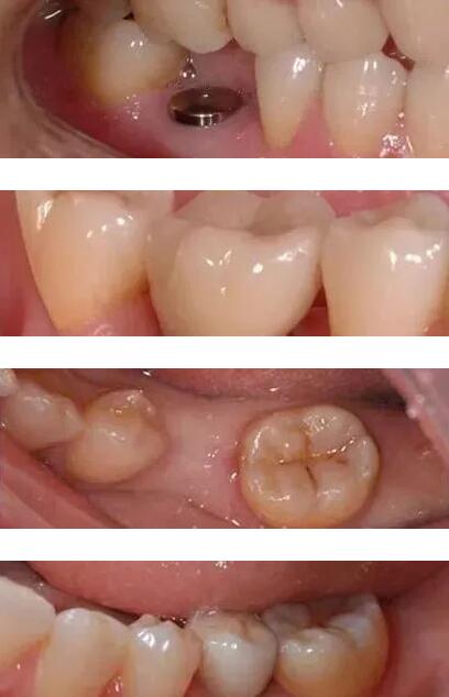 富华美容牙科种植牙单颗种植前后对比图