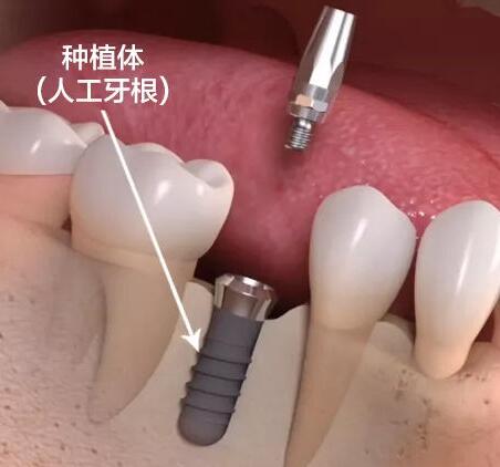种植牙种植体-富华美容牙科