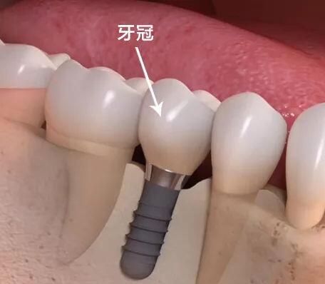 种植牙牙冠-富华美容牙科