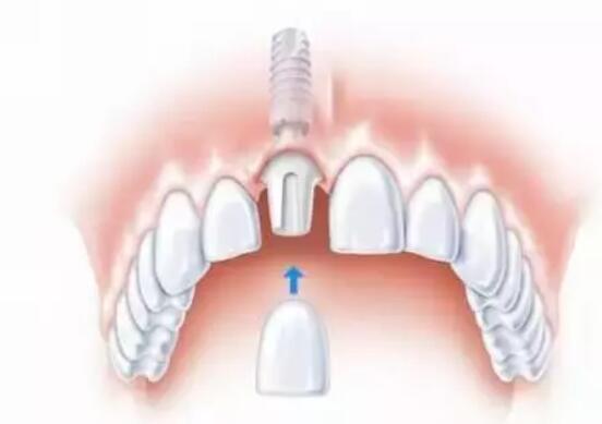 种植牙安装牙冠-富华美容牙科