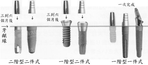 种植牙-富华美容牙科