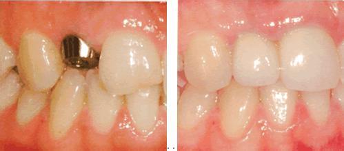 种植牙前后对比图-富华美容牙科