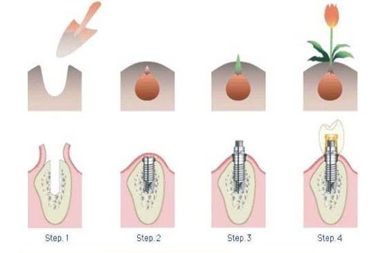 种植牙种植过程示意图-富华美容牙科